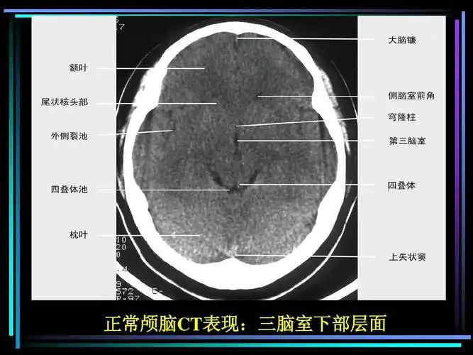 正常颅脑ct表现:三脑室下部层面 表现