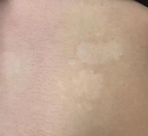 我也一直以为肚子这么多的白斑是汗斑看来真的错了