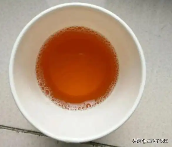 一文解开尿液发黄的真实原因|胆红素|排尿|肾脏|黄疸_网易订阅