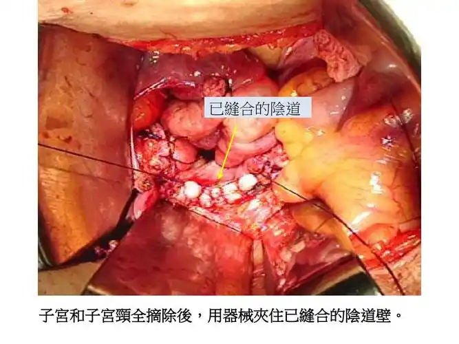 一般传统开腹 -- 子宫全摘除术