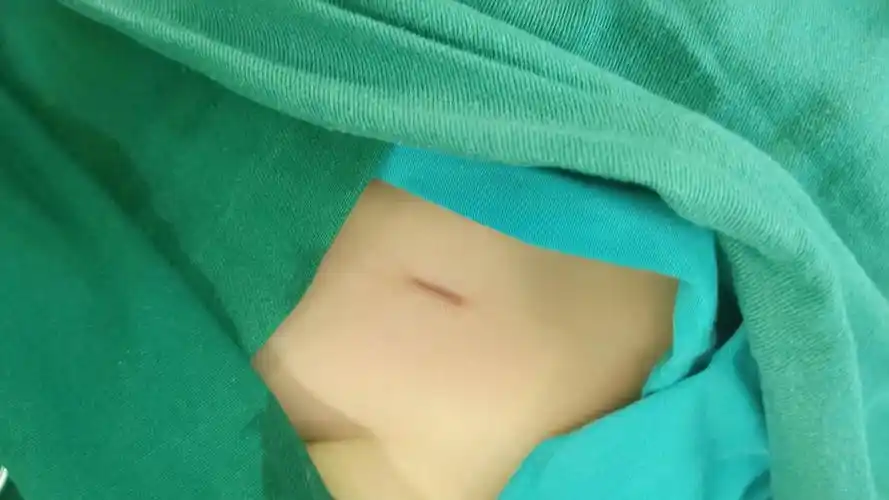 太和县人民医院疝气专科 小切口治愈小儿疝气,不住院,不拆线,痛苦小