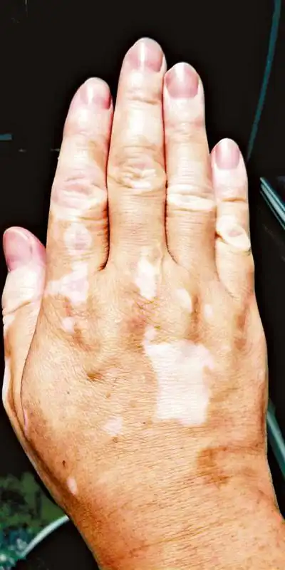 白癜风的特徵是皮肤因色素脱失而出现斑痕