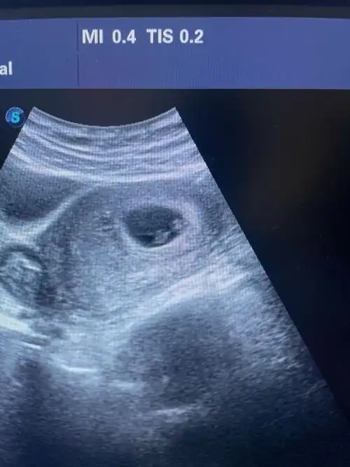 45天男孩胎囊图片