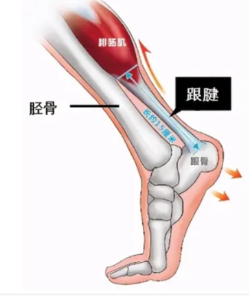 运动员止点性跟腱炎可能与长期超负荷训练有关.