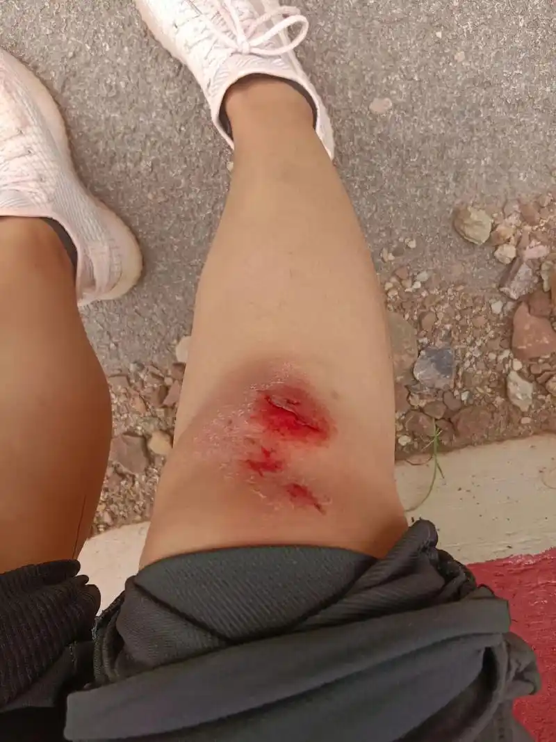 一不小心摔伤了腿,我没有责怪路不平,而是责怪自己不小心,看着 - 抖音