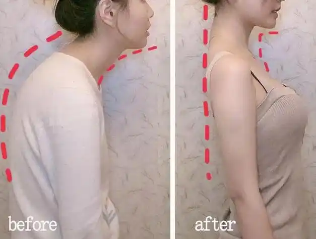 驼背女孩都在用每天10分钟肩直了富贵包不见了背越来越薄