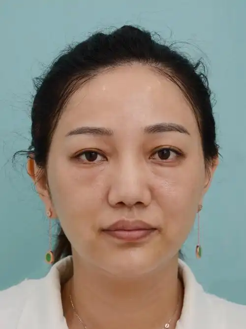 都说30岁之后皮肤会老化,我真的感觉到了,不仅没有_圈子-新氧美容整形