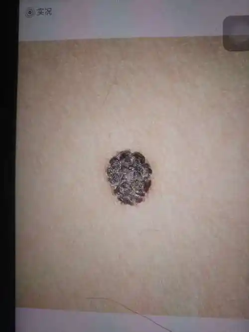 部分信息和图片因保护患者隐私已被医生屏蔽医生心得突然长出来的黑痣