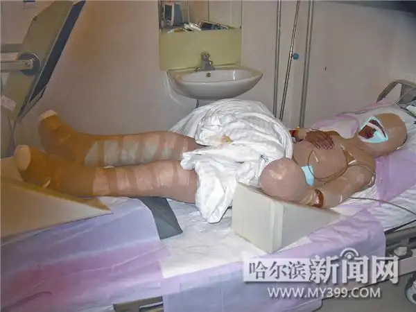 刘浩浩全身Ⅱ度Ⅲ度大面积烧伤.