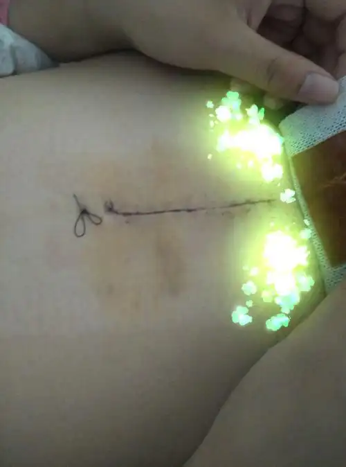 开腹手术后的疤痕越来越粗了,怎么办