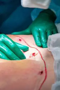 腹部脂肪组织的手术切除照片