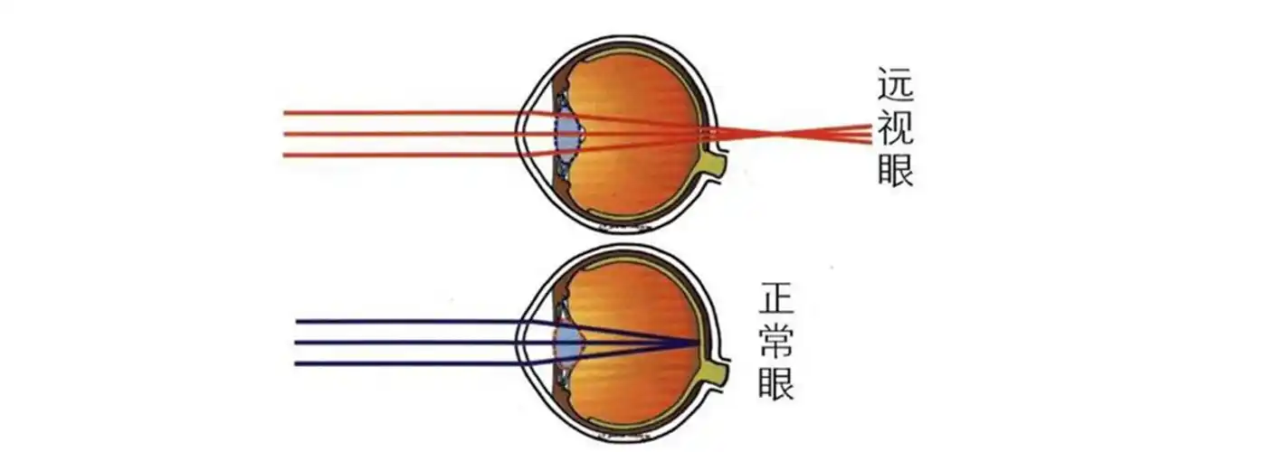 远视要不要给孩子配眼镜