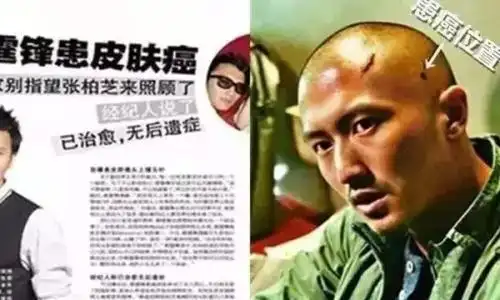 谢霆锋患癌是真的吗 谢霆锋皮肤癌好了嘛 谢霆锋皮肤癌怎么治好