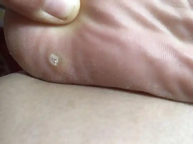 脚底板长的这个是鸡眼吗