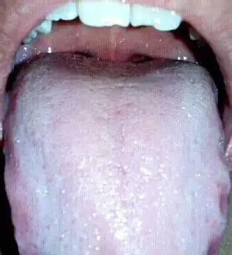 气虚血虚舌头图片