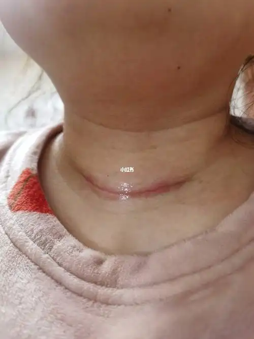 术后32天,这是术后一个月拍的,还是有点红,伤口有时还会疼.