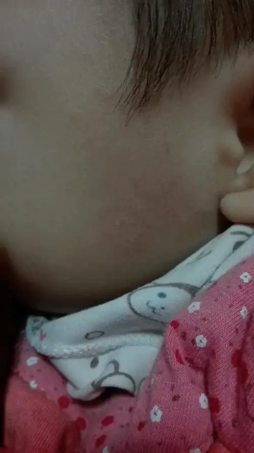 宝宝脸上有一小块,摸着很粗糙,跟个印是的,有些旮瘩,是怎么回事啊?