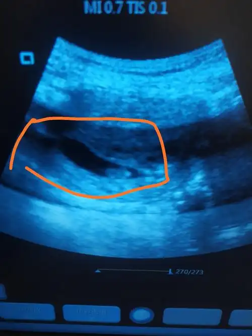 孕囊看男女准吗谁会看