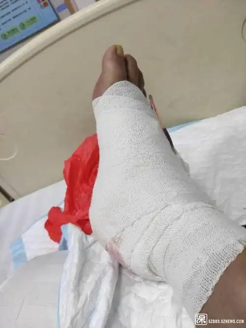 在工地工作受伤骨折