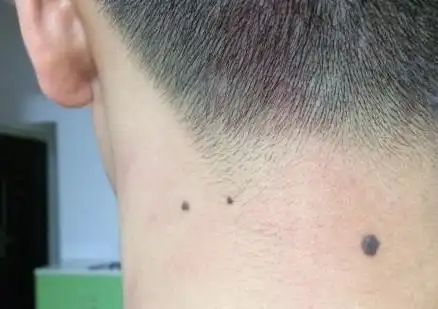 男人脖子后面有痣好不好