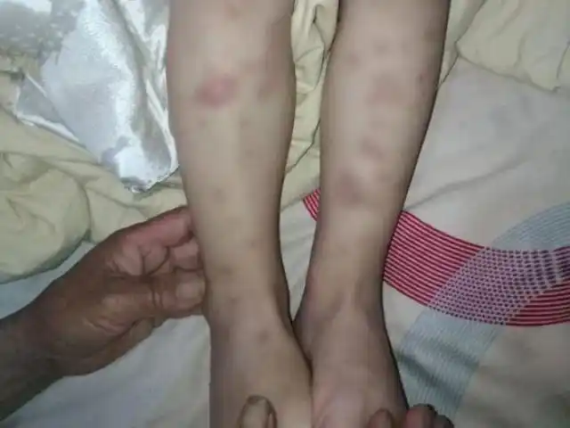 这些症状提示可能患有过敏性紫癜.