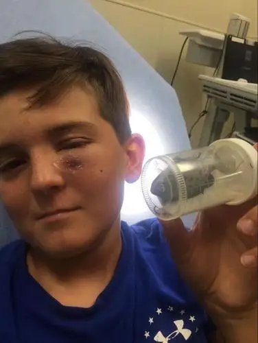 男孩钓鱼不慎钩到眼睛,手术中要求不用麻醉,第二天照常去钓鱼