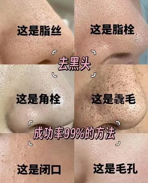 一张图分辨黑头