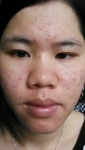 左右脸起痘痘怎么治疗?