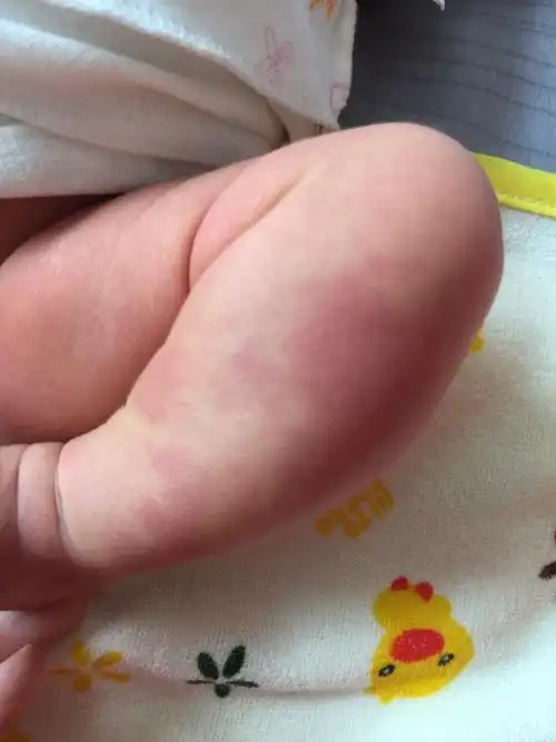 新生儿腿部红斑,小腿,而且明显略粗于另外一条腿.