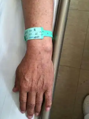 微笑手腕带 提高护理工作安全性