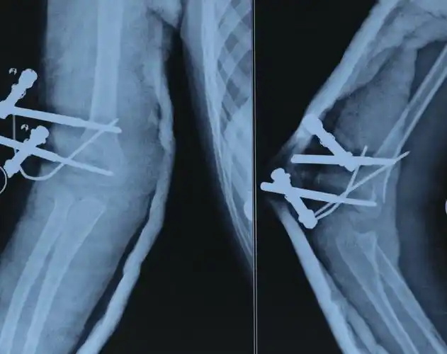 5岁儿童 肱骨髁上骨折 - 好大夫在线