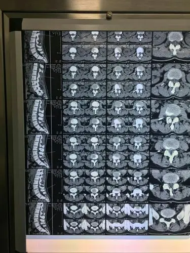 酒钢医院椎间孔镜微创治疗腰椎间盘突出 --外地患者慕名而来