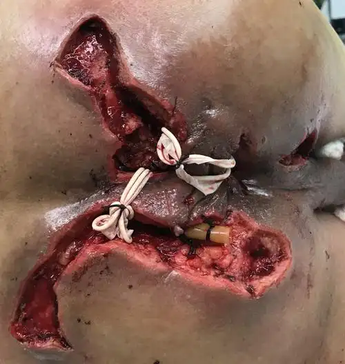 整合医学在高位复杂性肛瘘治疗中的应用