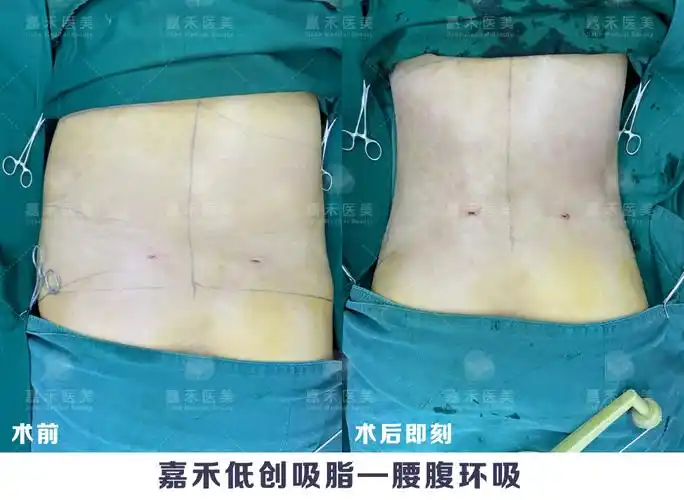 胖子吸脂会更重这是什么逻辑内附吸脂攻略