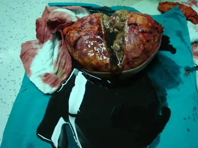 乳腺罕见肿瘤(附图片)结果及图片已更新!