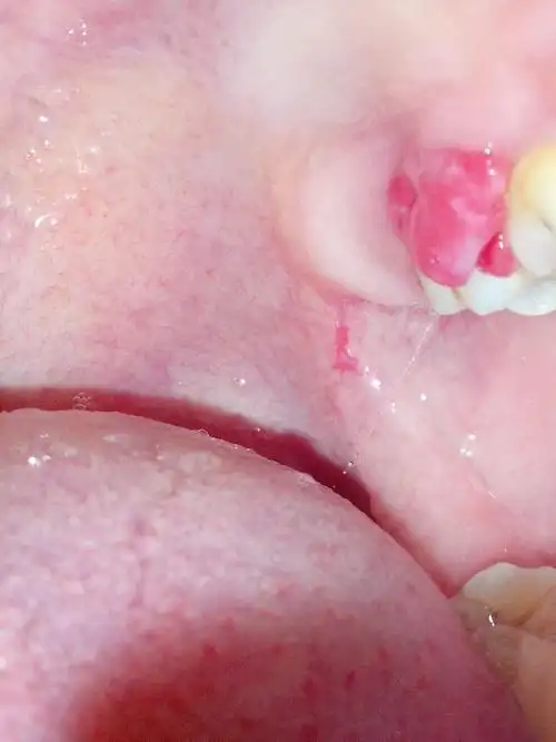 牙龈上长了一个类似息肉的东西,去医院看医生说有可能是牙龈瘤或息肉