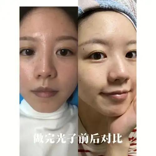 第一次做完光子嫩肤第四天的效果