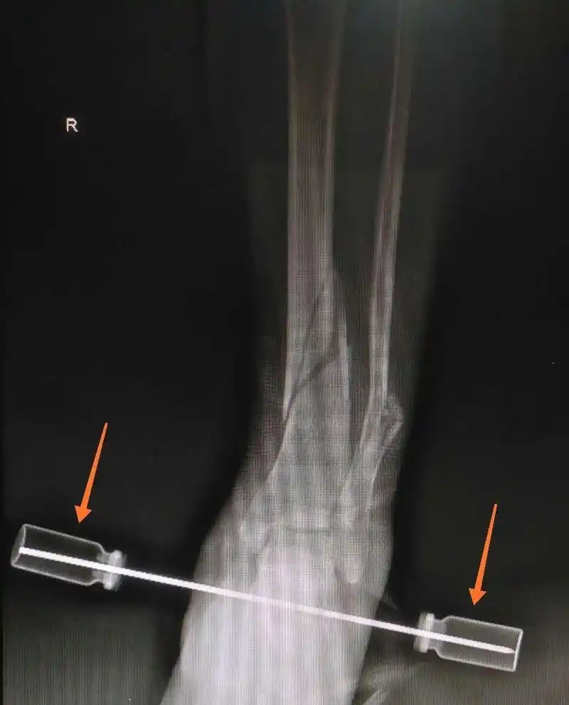 去医院做跟骨骨牵引治疗,牵引针上的小箭头标示处是什么?