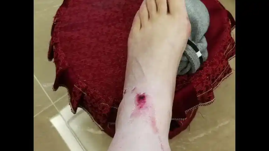 这姐姐的腿年前被摩托车撞伤,一个月来用各种方法治疗都无法散瘀