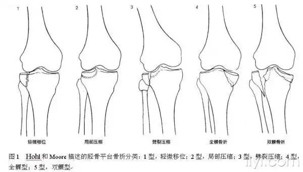【专题讲座】胫骨平台骨折的外科治疗!