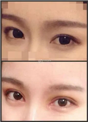 上海做的开眼角案例 - 上海割双眼皮医院