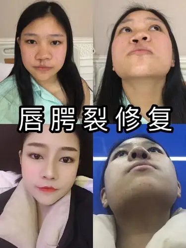 满意!兔唇可以治好吗"此中有真意"-第2张图片-华泰博客