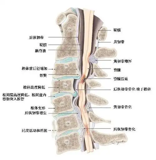 颈椎退行性疾病图解 - 好大夫在线