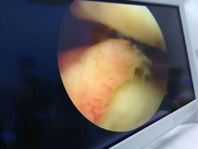 容易误诊的膝关节疼痛滑膜皱襞综合征