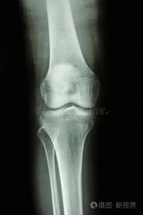 正常人膝关节