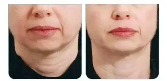 嘴角下垂一脸苦相教你如何拥有明星一样的微笑唇