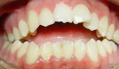 荒唐家里小孩牙齿不齐要等到12岁才能矫正