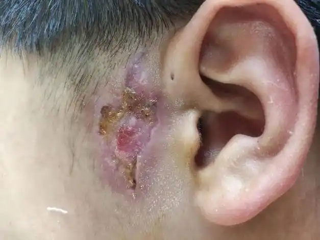 8个月宝宝左耳发炎流脓祸及性命,婆婆不让医治:那是"富贵仓",动了坏