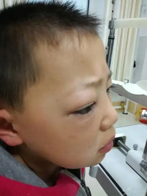 儿童不明原因眼球突出