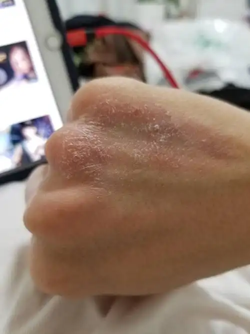 3条回答  癣的可能性大,建议你去医院的皮肤科面诊,确诊后再对症治疗